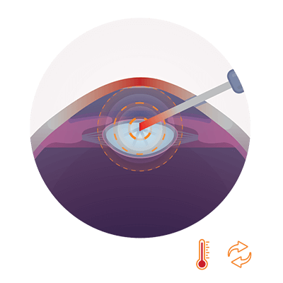 Ultraschall - hohe Energieabgabe ins Auge, Hitzeentwicklung im Auge. Risiko für Komplikationen an der Hornhaut